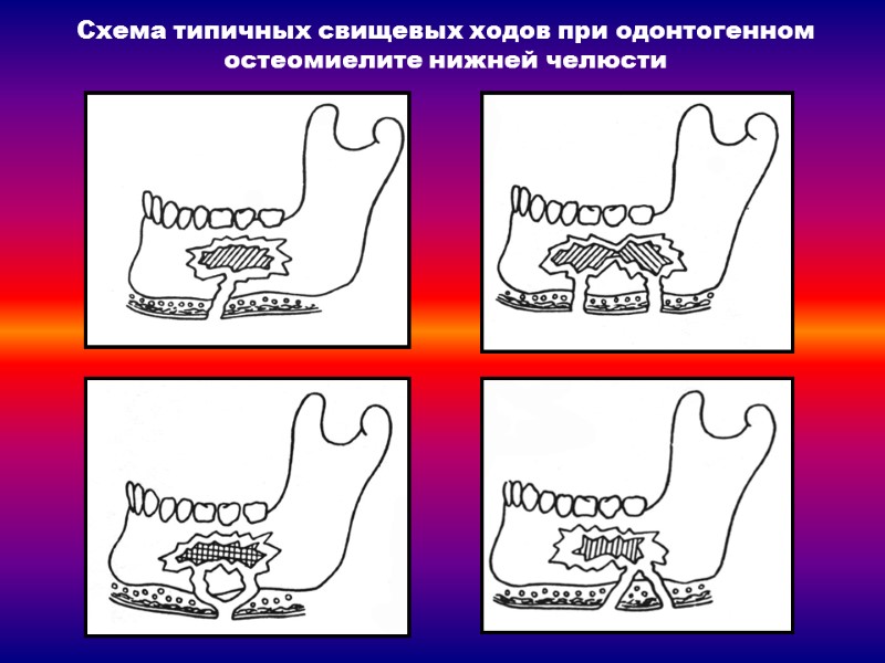 Схема типичных свищевых ходов при одонтогенном остеомиелите нижней челюсти